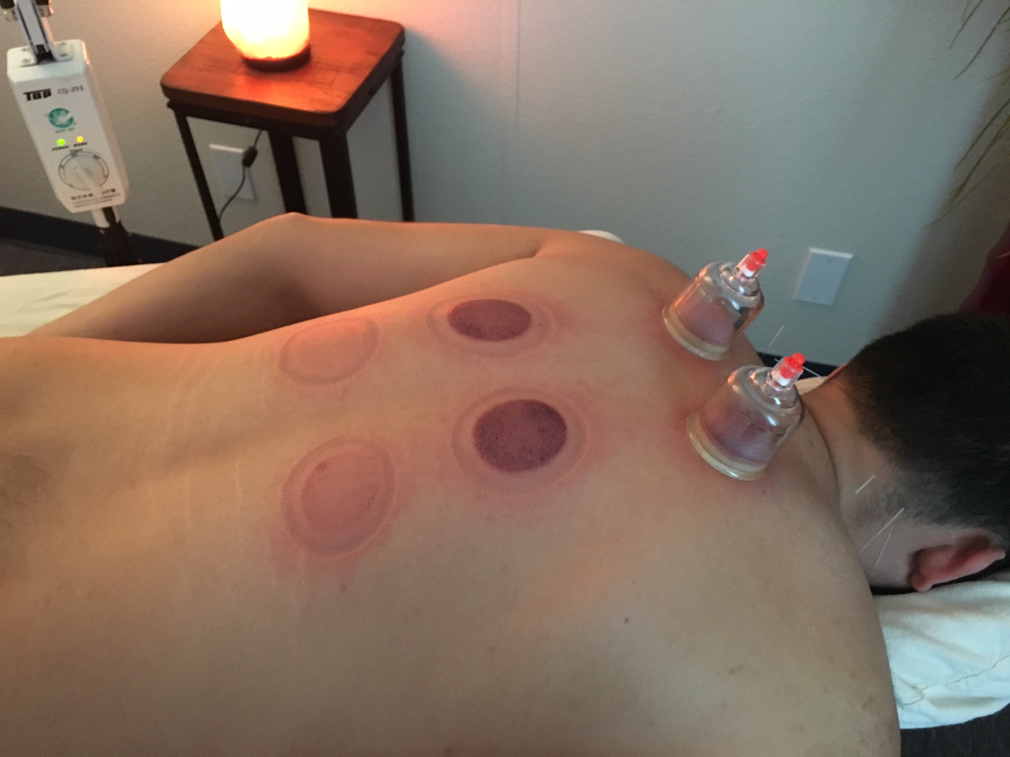 cupping services san diego